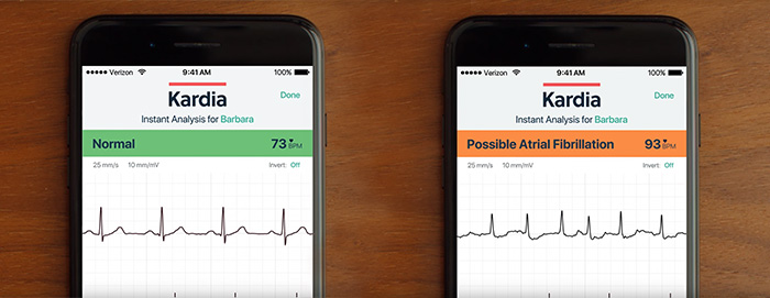  KardiaMobile 6-Lead Personal EKG Monitor – Six Views of The  Heart – Detects AFib and Irregular Arrhythmias – Instant Results in 30  Seconds – Works with Most Smartphones - FSA/HSA Eligible : Sports & Outdoors