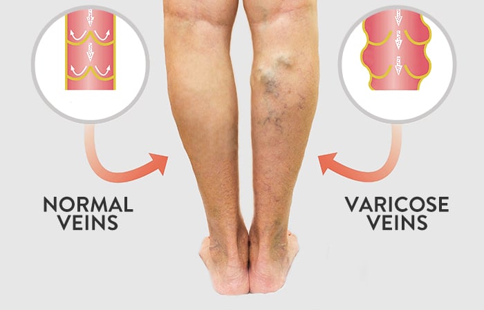 Illustration of difference between normal veins and varicose veins