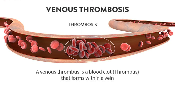 Venous thrombosis graphic showing blood clot forming in vein