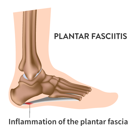 Diagram showing plantar fasciitis