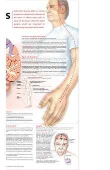 Anatomical Chart Company Parkinson's Disease Anatomical Chart ...